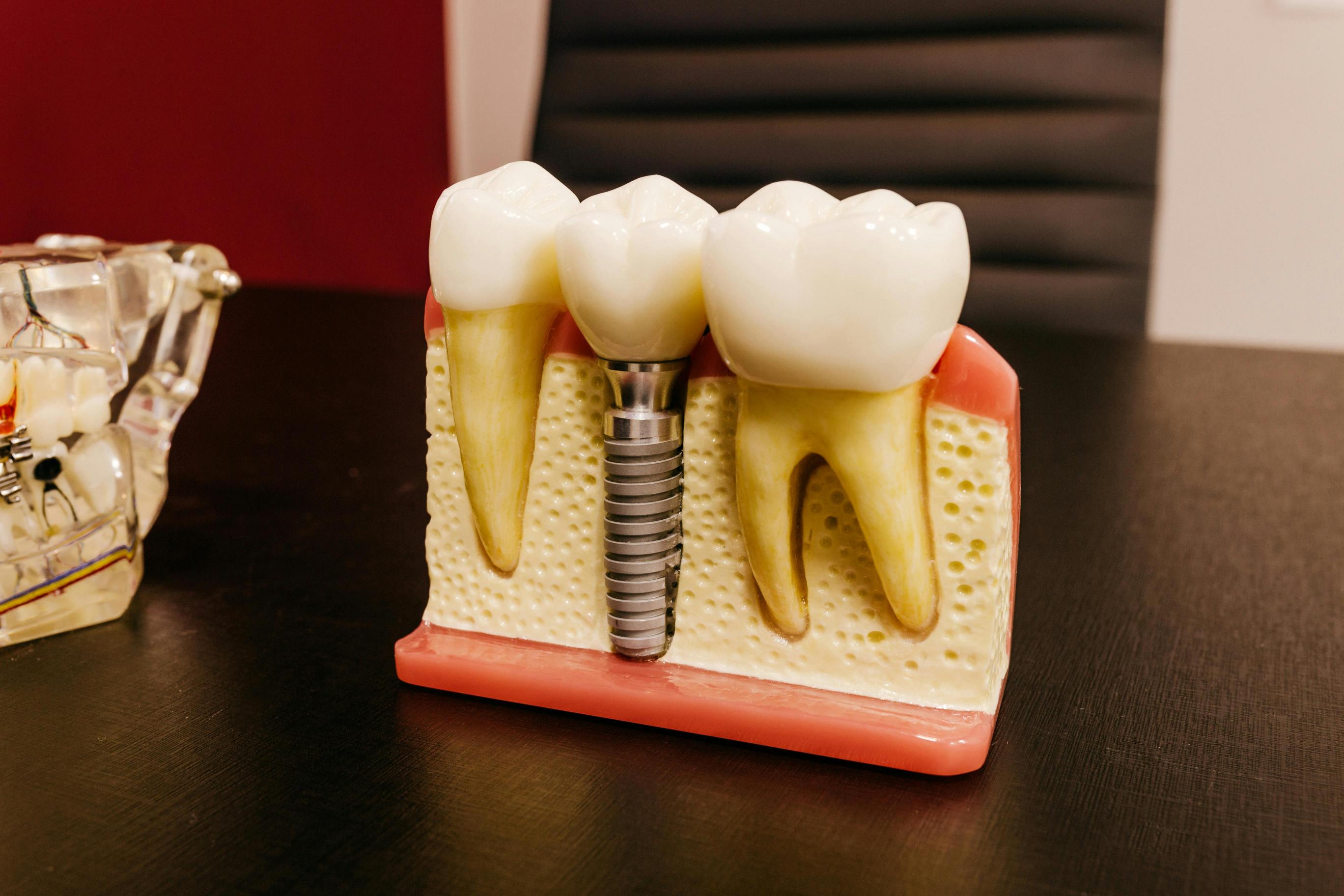 Implants Implants
